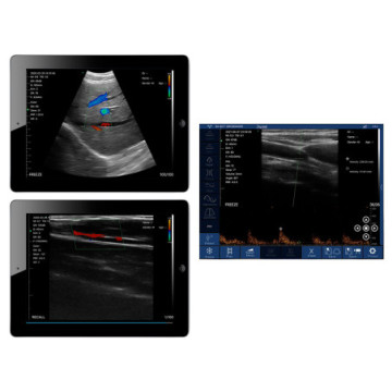Ecografo portatile lineare/convesso doppia testa wireless viatom - disponibile dicembre 2023
